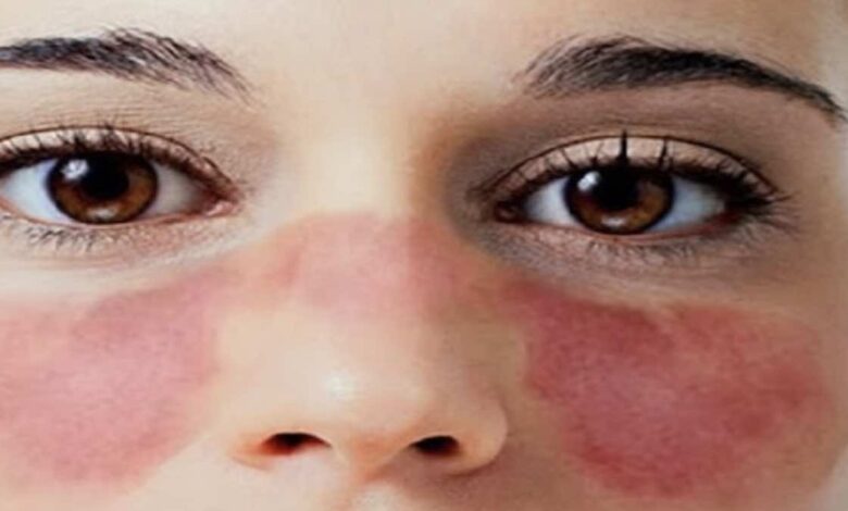 الذئبة الحمراء